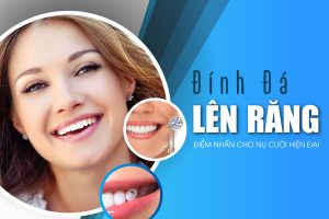 ĐÍNH ĐÁ LÊN RĂNG – BÍ QUYẾT ĐỂ CÓ NỤ CƯỜI DÀNH RIÊNG CHO BẠN