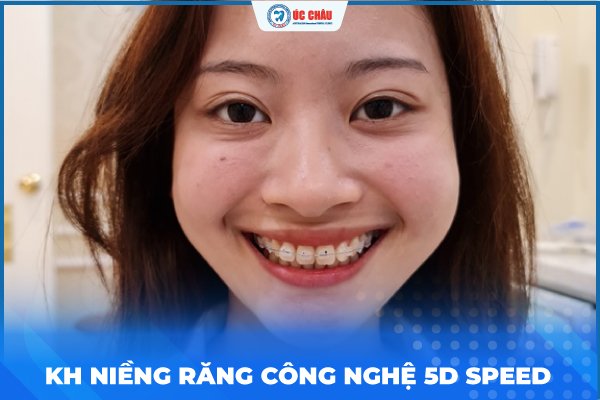 niềng răng công nghệ 5D Speed niềng răng công nghệ 5D Speed