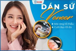 DÁN SỨ VENEER – THẨM MỸ HOÀN HẢO, BẢO VỆ RĂNG TỐI ĐA