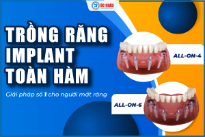 TRỒNG RĂNG IMPLANT TOÀN HÀM: LÀM 1 LẦN – DÙNG TRỌN ĐỜI