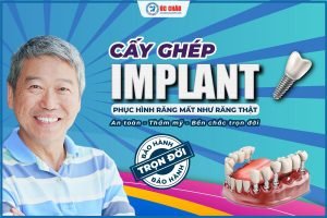 Trồng răng implant CBCT 5.0 – Giải pháp khôi phục mất răng hiệu quả