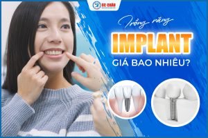  TRỒNG RĂNG IMPLANT GIÁ BAO NHIÊU? UPDATE KHUYẾN MÃI KHỦNG