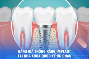 BẢNG GIÁ TRỒNG RĂNG IMPLANT TẠI NHA KHOA ÚC CHÂU BẢNG GIÁ TRỒNG RĂNG IMPLANT TẠI NHA KHOA ÚC CHÂU