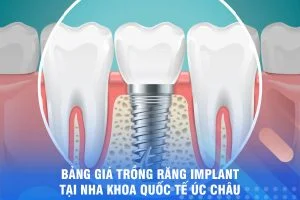  BẢNG GIÁ TRỒNG RĂNG IMPLANT TẠI NHA KHOA ÚC CHÂU