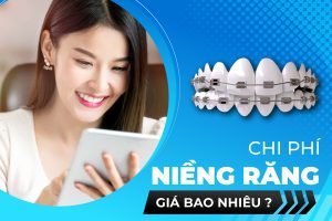  CHI PHÍ NIỀNG RĂNG GIÁ BAO NHIÊU TẠI THANH HÓA