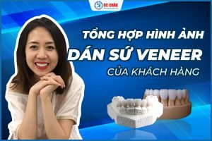  TỔNG HỢP HÌNH ẢNH DÁN SỨ VENEER CỦA KHÁCH HÀNG NHA KHOA ÚC CHÂU