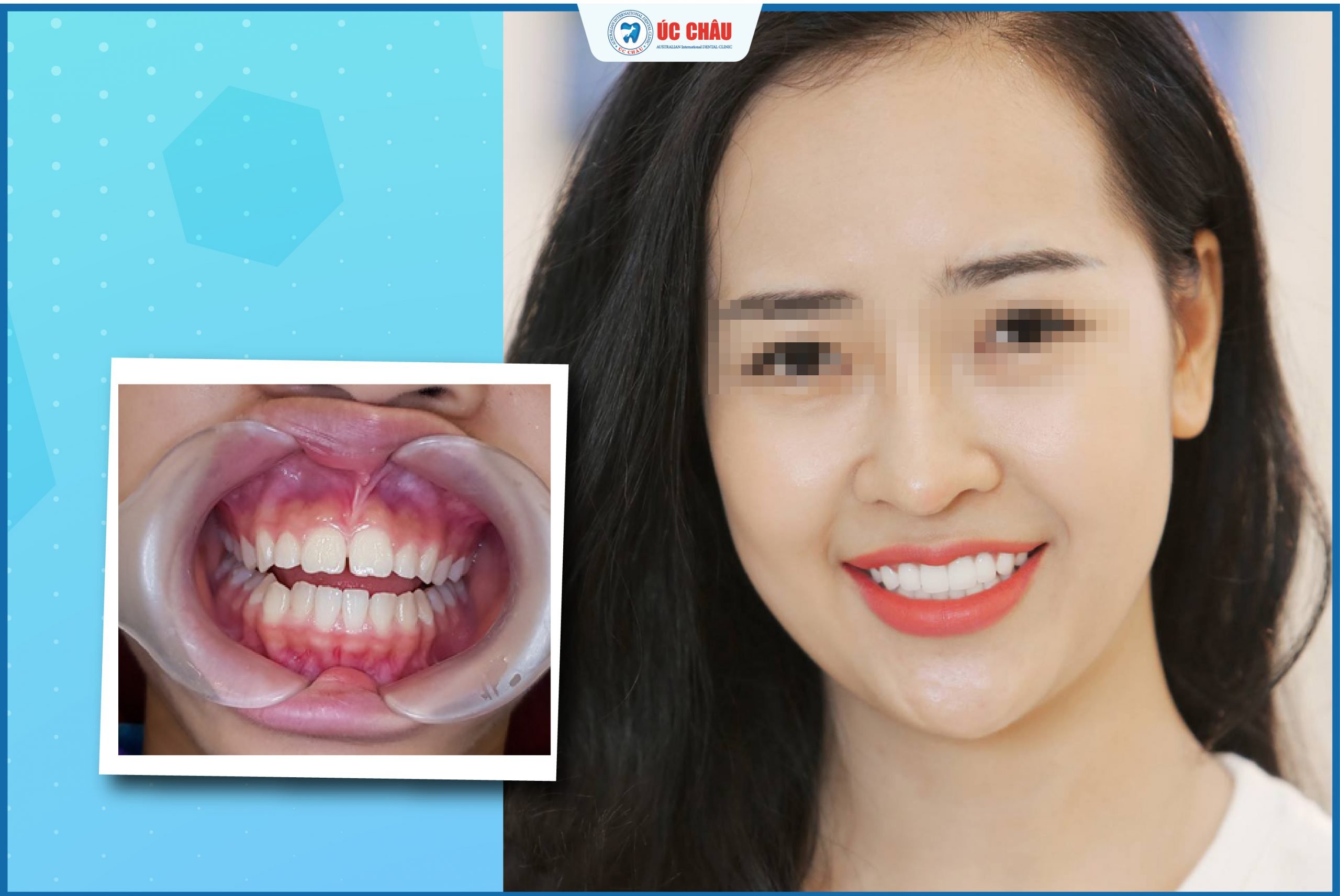 hình ảnh dán sứ veneer hình ảnh dán sứ veneer