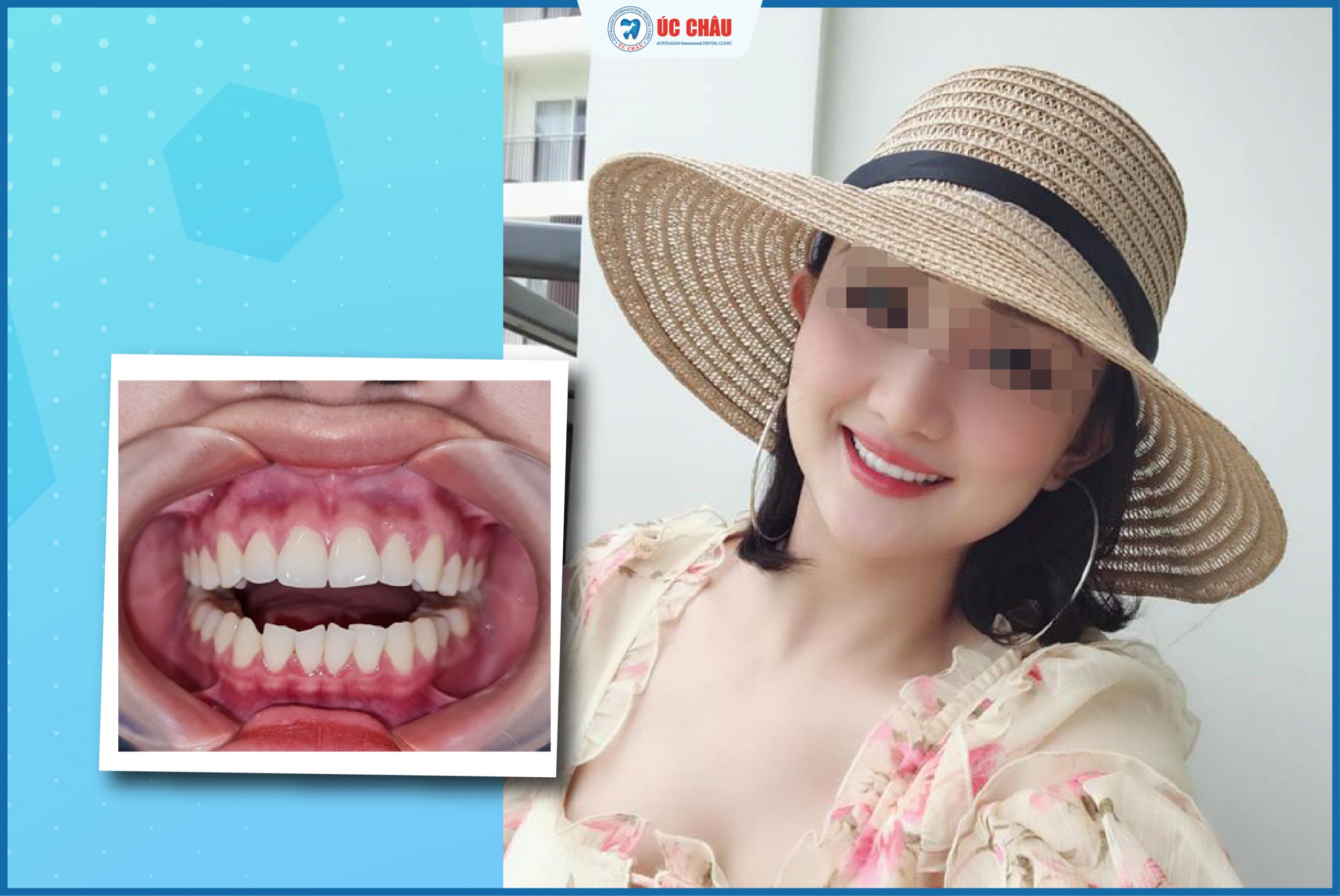 hình ảnh dán sứ veneer hình ảnh dán sứ veneer