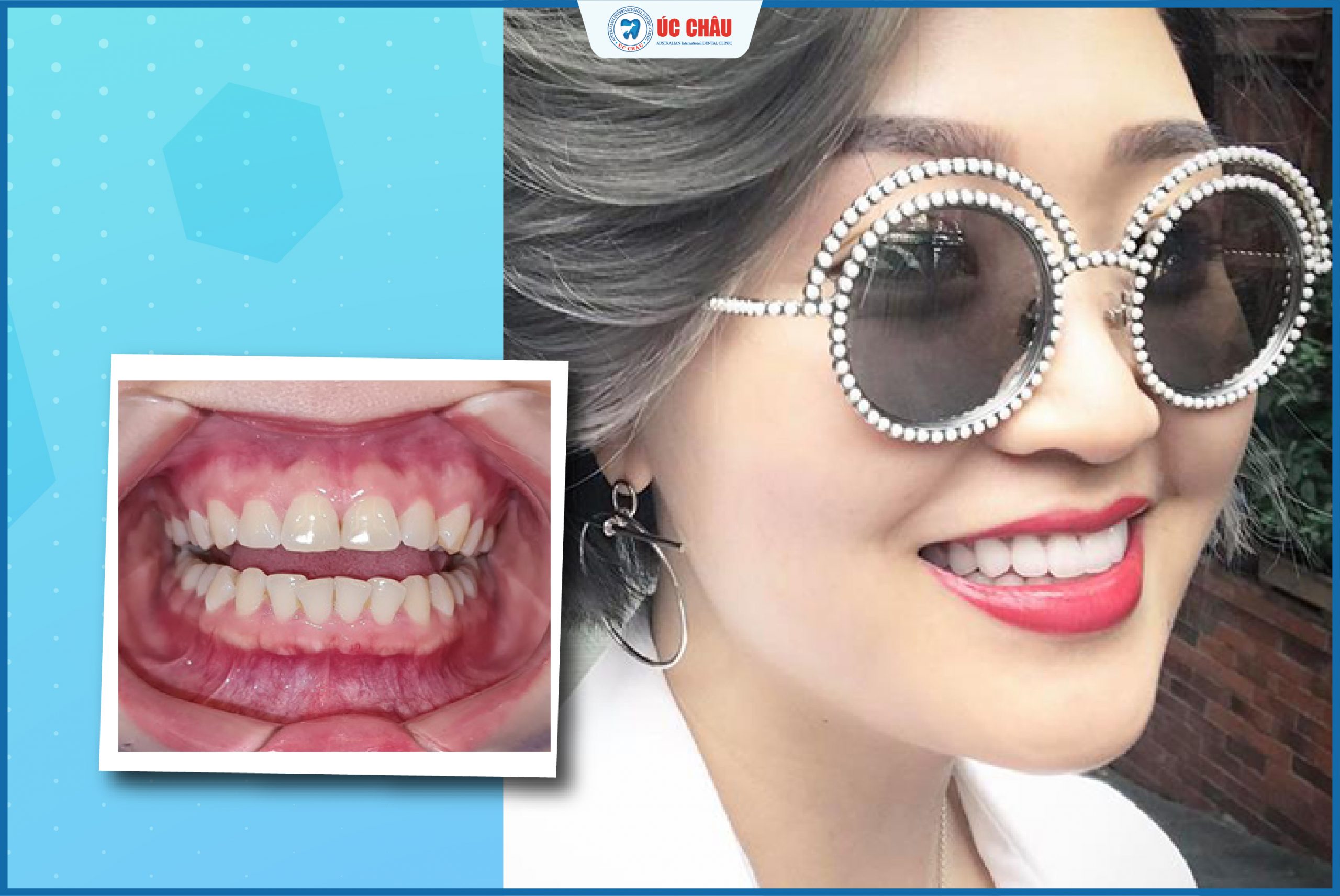 hình ảnh dán sứ veneer hình ảnh dán sứ veneer