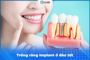  TRỒNG RĂNG IMPLANT Ở ĐÂU TỐT? ĐỊA CHỈ UY TÍN THANH HÓA
