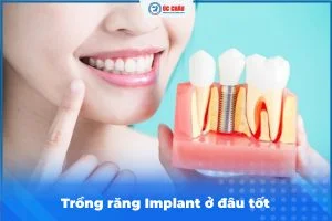 TRỒNG RĂNG IMPLANT Ở ĐÂU TỐT? ĐỊA CHỈ UY TÍN THANH HÓA TRỒNG RĂNG IMPLANT Ở ĐÂU TỐT? ĐỊA CHỈ UY TÍN THANH HÓA