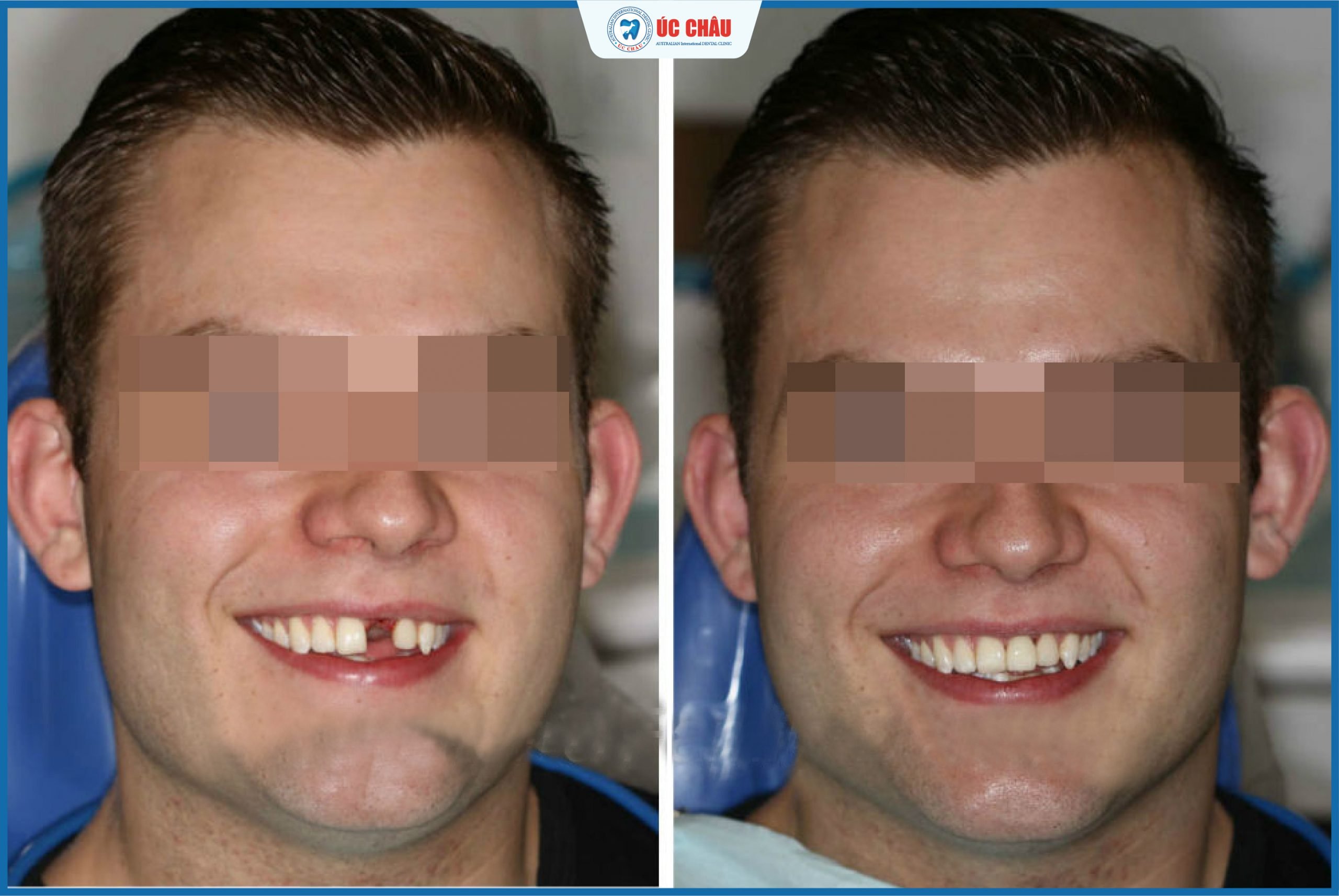 trồng răng implant ở đâu tốt trồng răng implant ở đâu tốt