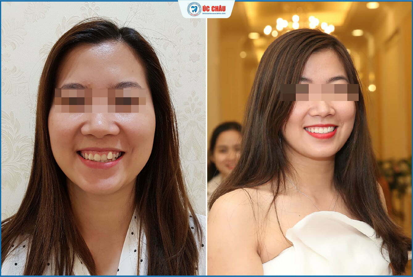hình ảnh niềng răng đẹp hình ảnh niềng răng đẹp