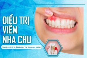 Viêm nha chu – Căn bệnh răng miệng nguy hiểm cẩn điều trị kịp thời