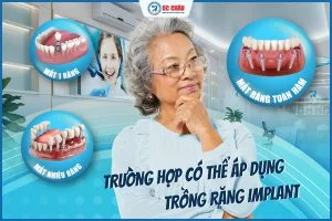  GIÁ TRỒNG RĂNG IMPLANT MỚI VÀ CHI TIẾT TỪNG HÃNG
