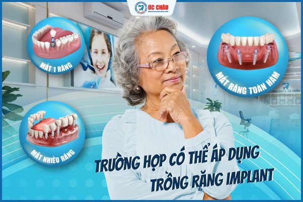 giá trồng răng implant