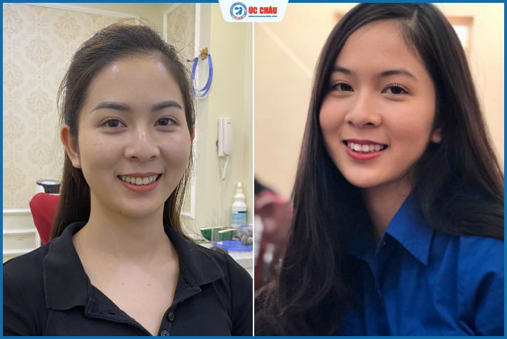 hình ảnh niềng răng đẹp hình ảnh niềng răng đẹp