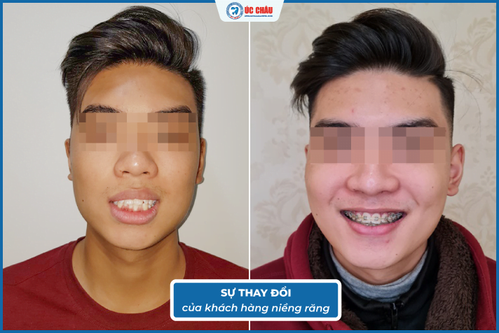 hình ảnh niềng răng đẹp hình ảnh niềng răng đẹp