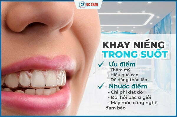 niềng răng là gì niềng răng là gì