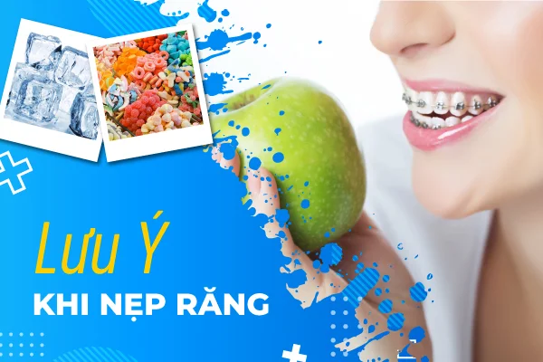 nẹp răng nẹp răng