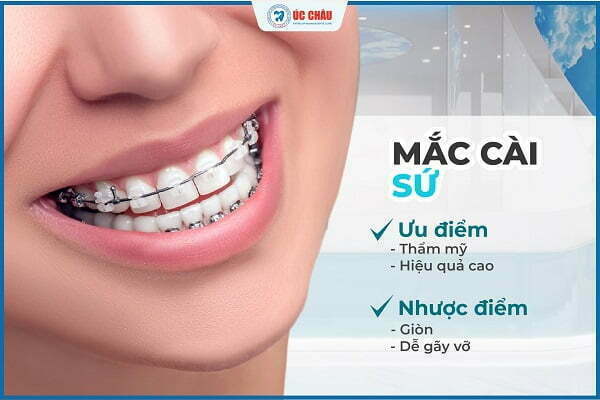 niềng răng là gì niềng răng là gì