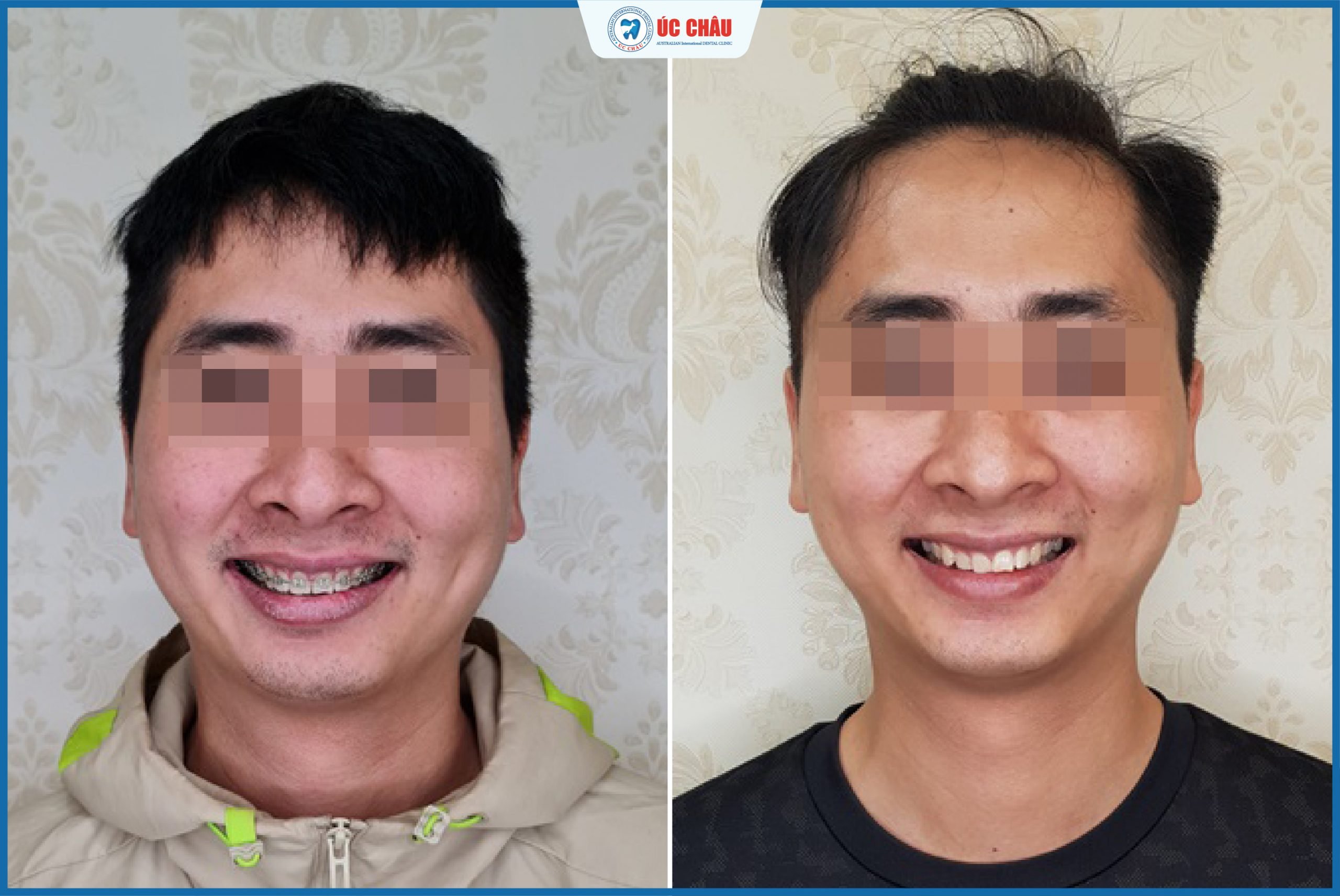 hình ảnh niềng răng đẹp hình ảnh niềng răng đẹp