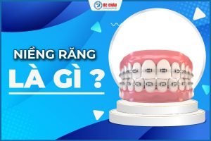  Niềng răng là gì? Tổng hợp các loại niềng răng phổ biến