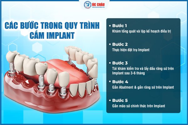 giá trồng răng implant