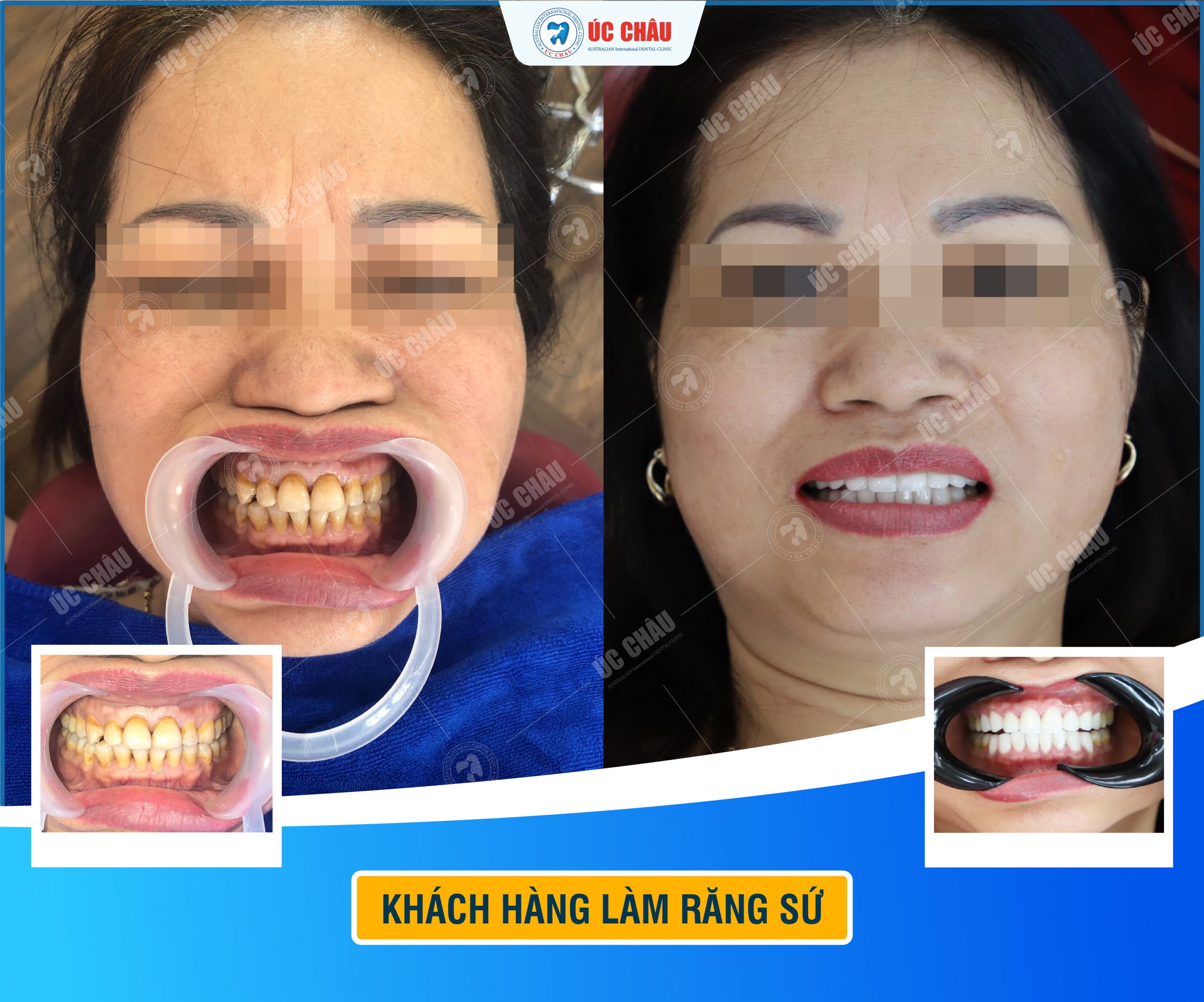Hình ảnh bọc răng sứ ấn tượng Hình ảnh bọc răng sứ ấn tượng