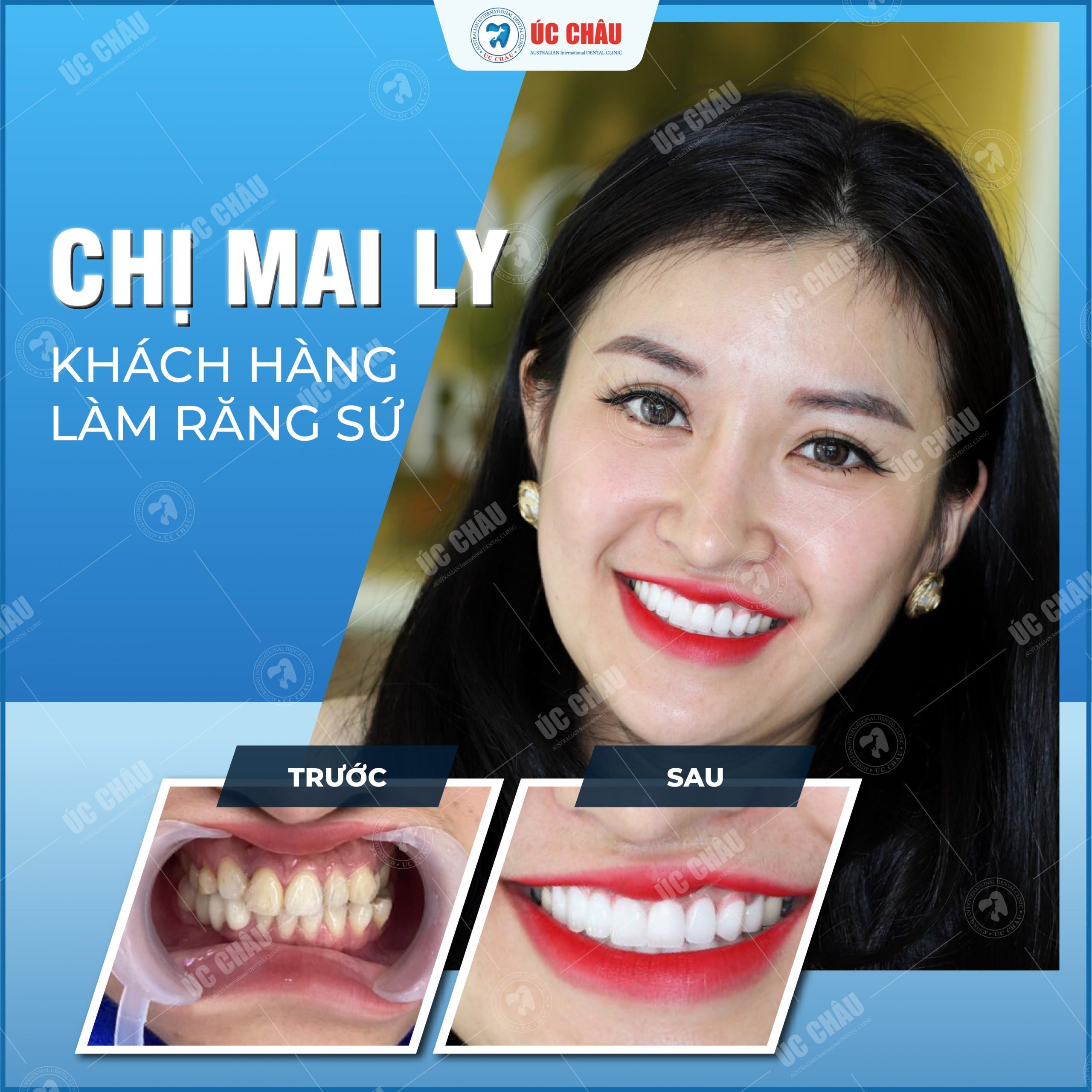 Hình ảnh bọc răng sứ ấn tượng Hình ảnh bọc răng sứ ấn tượng
