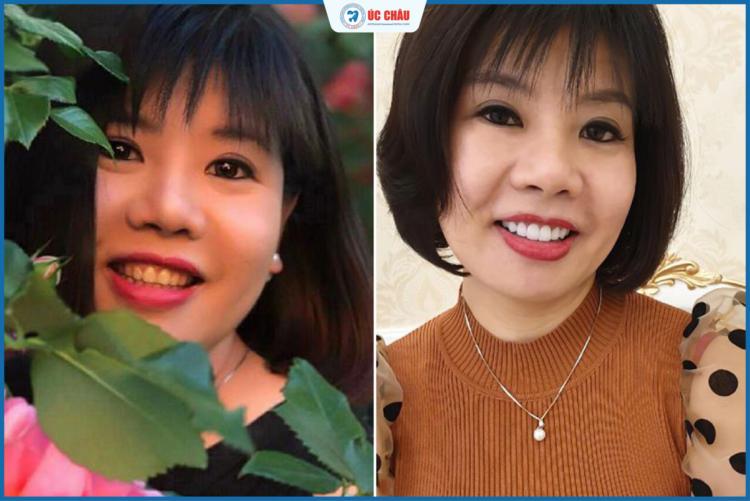 Hình ảnh bọc răng sứ ấn tượng Hình ảnh bọc răng sứ ấn tượng