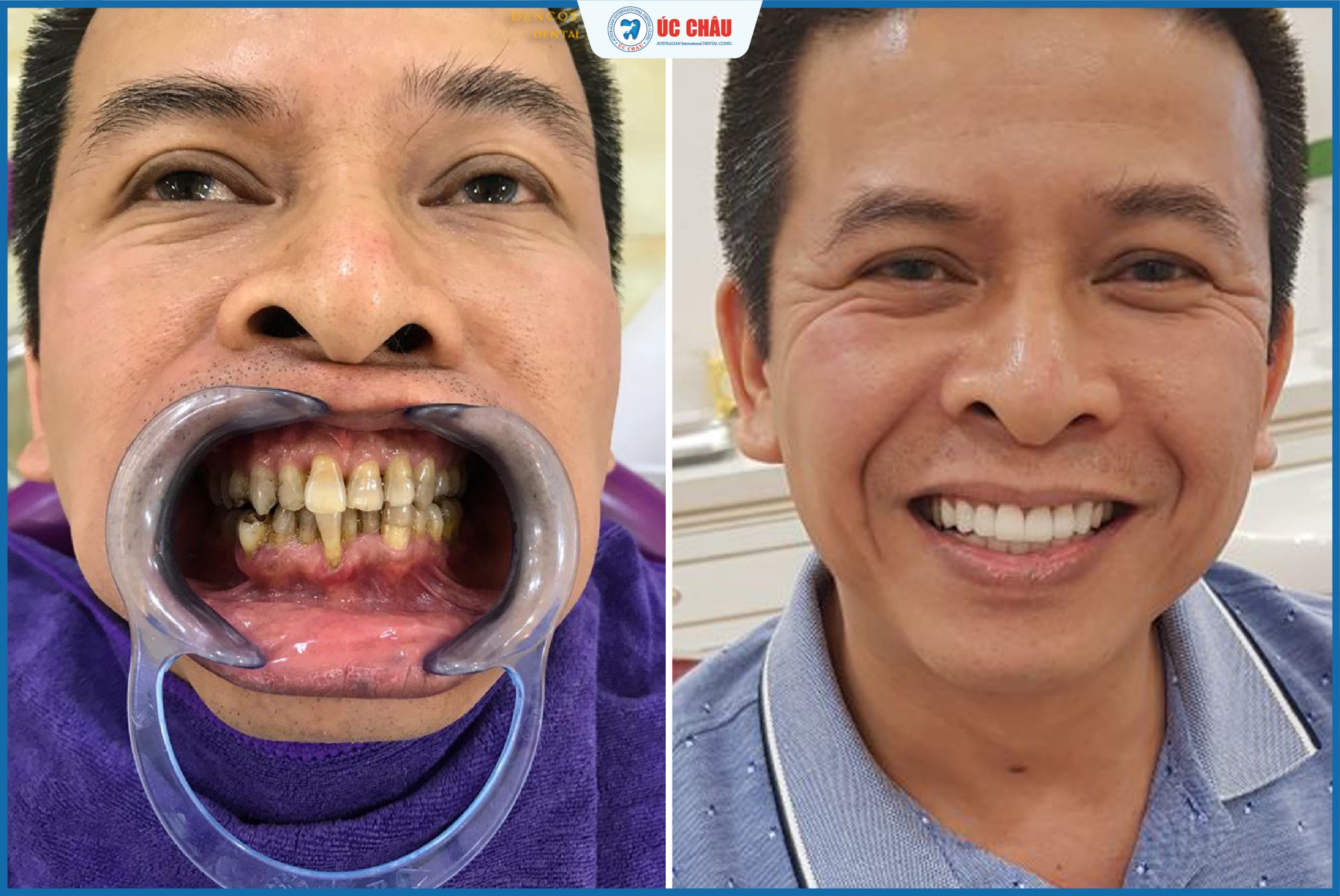 Hình ảnh bọc răng sứ ấn tượng Hình ảnh bọc răng sứ ấn tượng