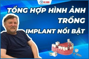 Hình ảnh trồng răng implant nổi bật tại Nha khoa Úc Châu Hình ảnh trồng răng implant nổi bật tại Nha khoa Úc Châu