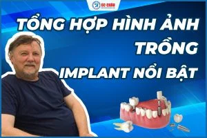  Hình ảnh trồng răng implant nổi bật tại Nha khoa Úc Châu