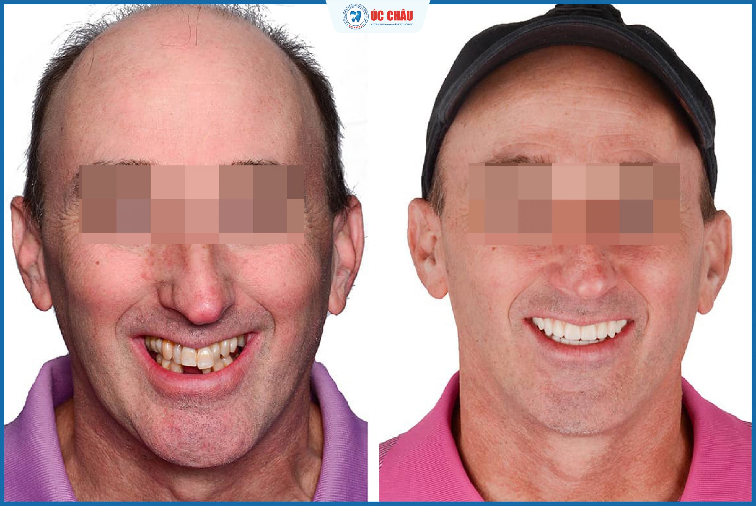 hình ảnh trồng răng implant hình ảnh trồng răng implant