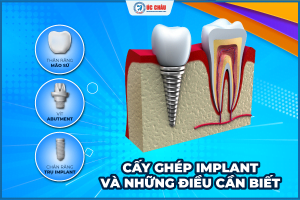 Quy trình cấy ghép răng implant an toàn tại Nha khoa Quốc tế Úc Châu Quy trình cấy ghép răng implant an toàn tại Nha khoa Quốc tế Úc Châu