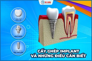 Quy trình cấy ghép răng implant an toàn tại Nha khoa Quốc tế Úc Châu Quy trình cấy ghép răng implant an toàn tại Nha khoa Quốc tế Úc Châu