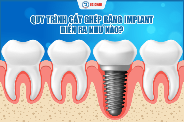 quy trình cấy ghép răng implant quy trình cấy ghép răng implant