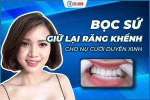  Bọc răng sứ giữ lại răng khểnh | Nha khoa Quốc tế Úc Châu