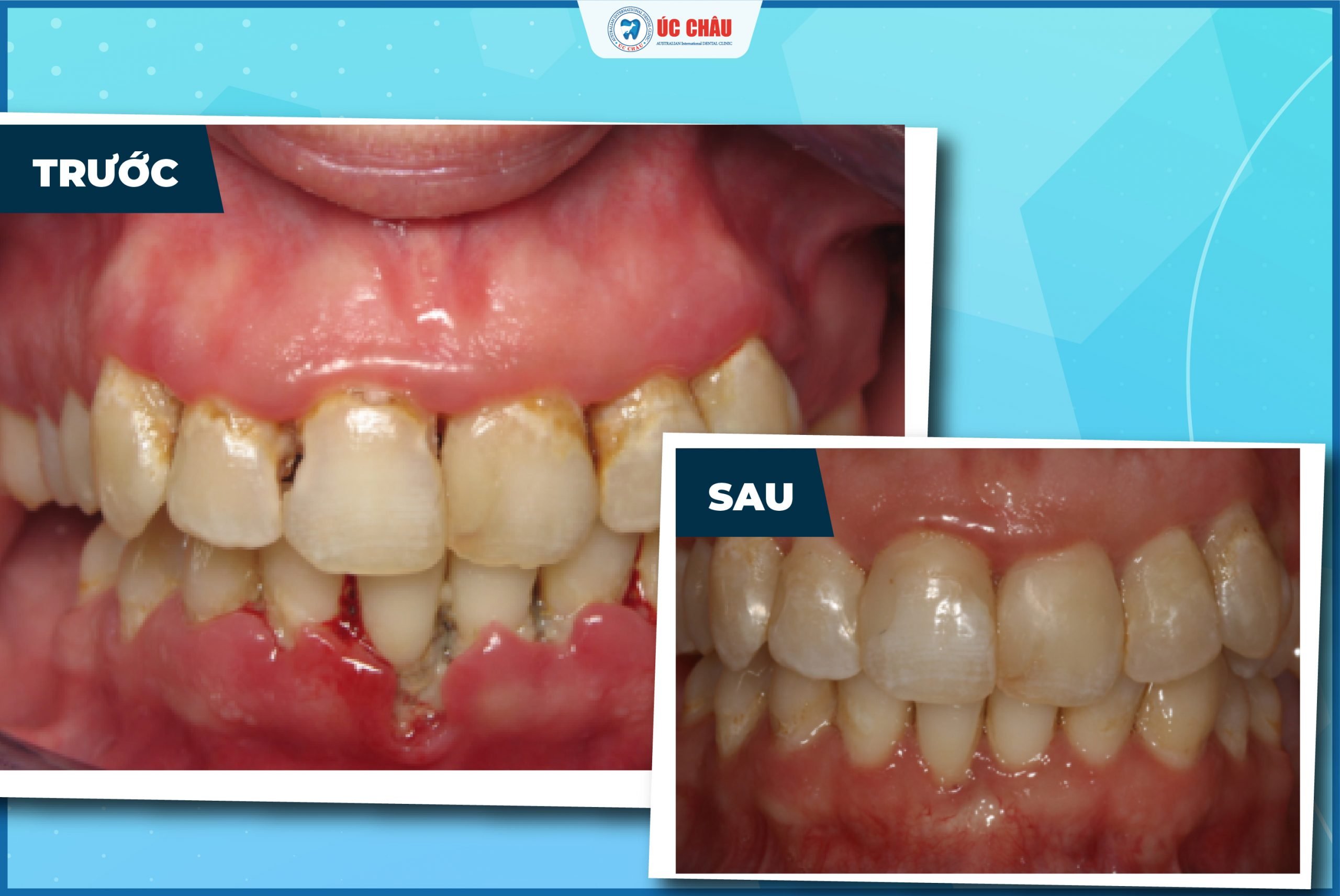 bệnh viêm nha chu bệnh viêm nha chu