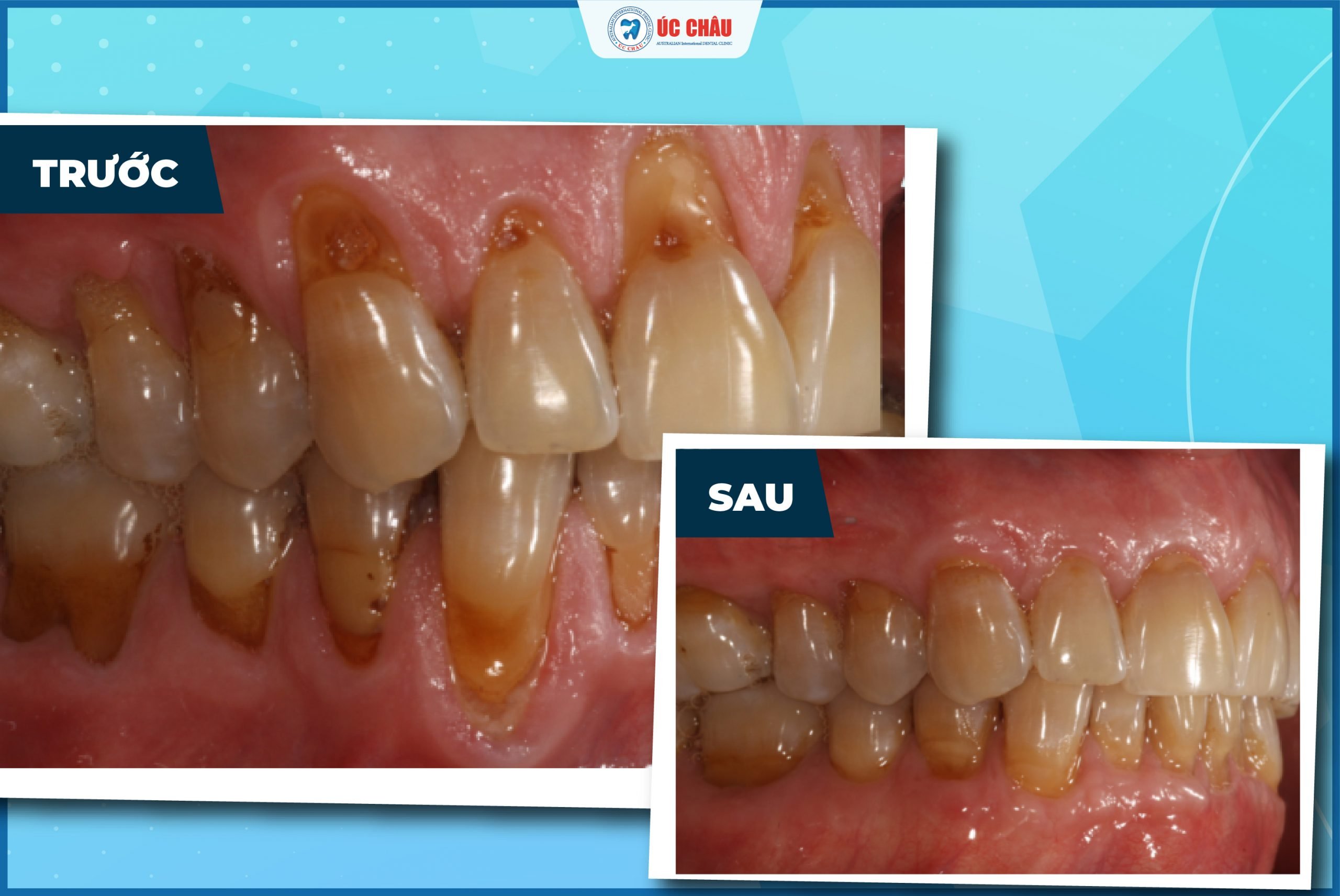 bệnh viêm nha chu bệnh viêm nha chu