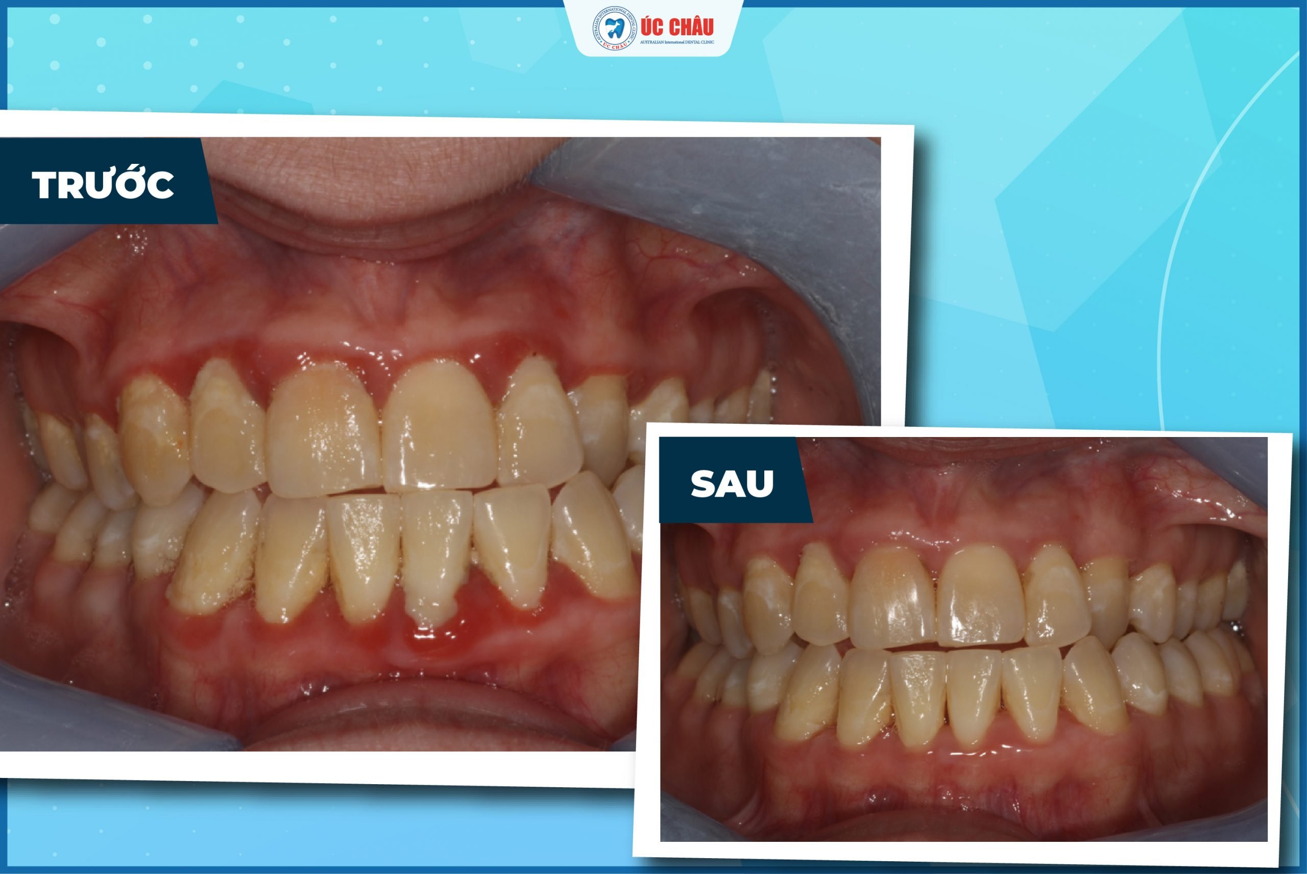 bệnh viêm nha chu bệnh viêm nha chu