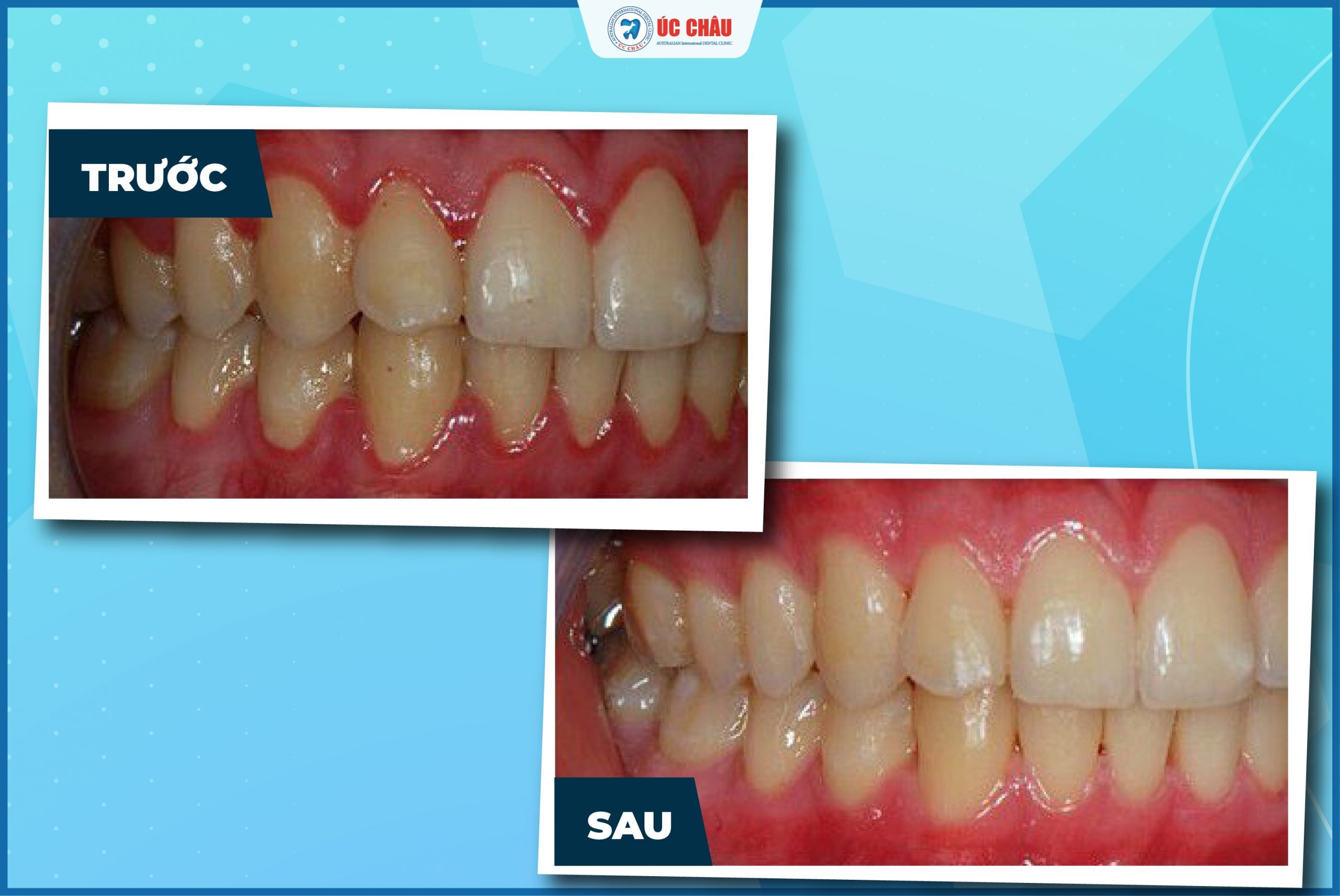 bệnh viêm nha chu bệnh viêm nha chu